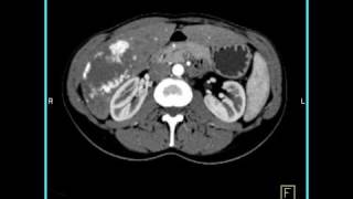 Abdomen Liver Cavernous Hemangioma of the Liver1 of 9 [upl. by Anyat]