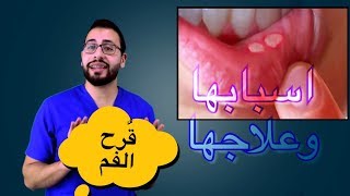 ❓كيف تتخلصون من تقرحات الفم ؟ و طرق تجنب الاصابة بها ؟؟ [upl. by Earlie]