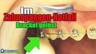 Im ZahnspangenNotfall ein Bracket hat sich gelöst feste Zahnspange Kieferorthopöde  Orthodentix [upl. by Stasny]