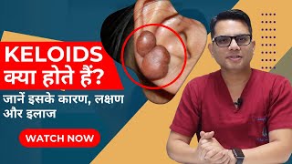 What are the Keloids  Keloid Treatment in Delhi  Best Skin Clinic Delhi  SkinQure  Dr Jangid [upl. by Meerak57]