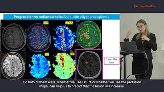 Prof Nadya Pyatigorskaya Enhancing NeuroOncology Outcomes [upl. by Gilligan]