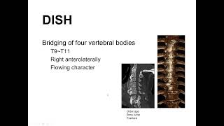 Basics Diffuse Idiopathic Skeletal Hyperostosis DISH Spine 서경진 [upl. by Sholley244]