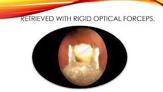 Corn 🌽 Seed In Paediatric Airway  Rigid Bronchoscopic Intervention [upl. by Ialohcin]