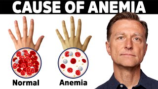 The Hidden Cause of Anemia Youve Never Heard About [upl. by Yrocal]