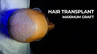 Sapphire Fue Hair Transplant  All Process [upl. by Hyrup]