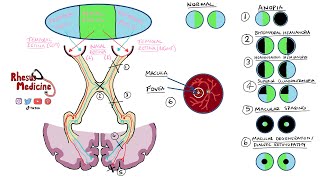 Visual Field Defects and Optic Nerve Pathway  Homonymous Hemianopia Bitemporal Hemianopia NEW 2020 [upl. by Ecirum]