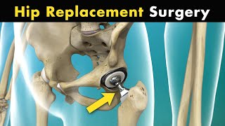 How Hip Replacement Surgery Is Performed  Hip Arthroplasty 3D Animation [upl. by Aubigny]