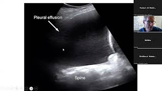 2024 19 Management of empyema in children [upl. by Idalla]