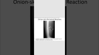 Onion skin periosteal reactionrevision neetpg inicet [upl. by Schnell]