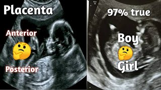 How to find gender in placenta  during pregnancy in kannada  97  is correct [upl. by Salisbarry]