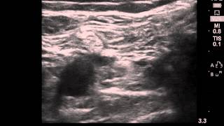 Popliteal Ultrasound Imaging [upl. by Etnuahs]