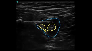 Popliteal block ultrasound guided classic technique [upl. by Eeral]