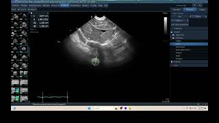 IQ 309 TFAST LUNF MEDIASTINAL LN ENLARGEMENT ASCITES BLOOD LYMPHOMA ULTRASOUND [upl. by Onaicram]