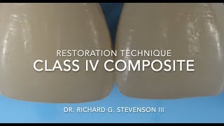 Class IV Composite Restoration  Restoration Technique [upl. by Findley]