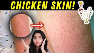 How to Get Rid of Keratosis Pilaris Causes Triggers Solutions [upl. by Annim]