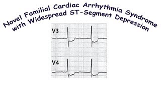 Novel Familial Cardiac Arrhythmia Syndrome Bundgaards syndrome [upl. by Cutter]