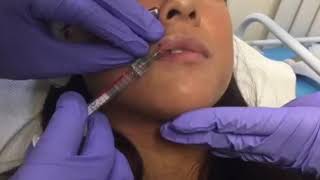 Lip enhancement with Belotero LIPS  Shape amp Contour by Dr Dev Patel [upl. by Alber75]