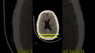 Lacunar Infarct in left gangliocapsular region radiology shortvideo ct brain [upl. by Nidia]