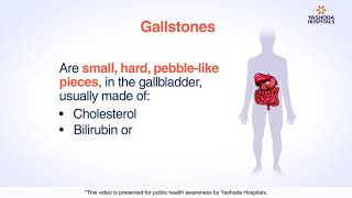 Gallstones  Cholelithiasis Symptoms Causes Diagnosis and Treatment [upl. by Zakarias]