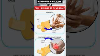 Guillain Barre Syndrome gbs  guillain barre syndrome treatment homeopathy  guillainbarresyndrome [upl. by Melessa]