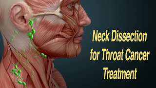 Neck Dissection Surgery for Throat Cancer Treatment MRND RND [upl. by Oeak130]