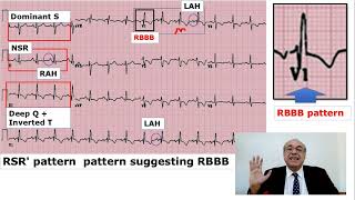 EKG Trainer Case 2 Answer CME internalmedicine ecg محاضراتباطنة امراضباطنة [upl. by Hunger]