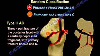 Calcaneal IntraArticular Fractures Sanders  Everything You Need To Know  Dr Nabil Ebraheim [upl. by Okihsoy207]