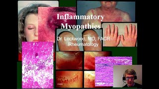 14 Inflammatory Myopathy Dermatomyositis Polymyositis Inclusion Body Myositis and others [upl. by Bower]