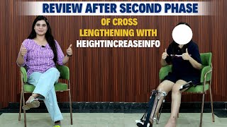 Review after Second phase of cross lengthening with heightincreaseinfo  Height increase Surgery [upl. by Noah]