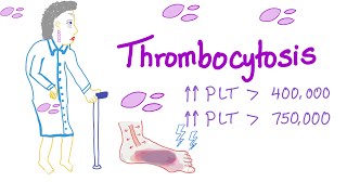 Thrombocytosis Primary and Secondary  Why Is My Platelet Count High  Hematology [upl. by Theis]