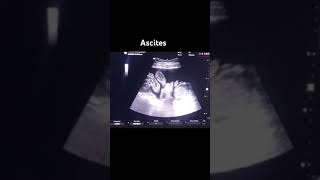 Ultrasound  Ascites Utrasound video [upl. by Janice]