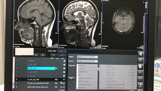 Epilepsi MR Nasil CekilirEpilepsi NedirMR Ogreniyorum [upl. by Christin]