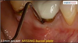 How to handle an 11mm pocket on the buccal [upl. by Radborne439]