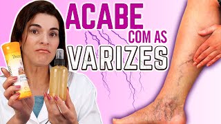 ACABE Com as VARIZES usando essa Receita e Dicas [upl. by Arymat]