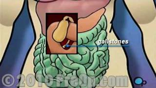 Gallbladder Removal Laparoscopic PreOp® Patient Education Feature [upl. by Bordy]