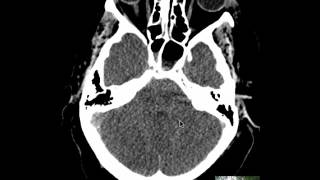 Heart attack with brain edema [upl. by Donni644]