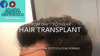 TRAPIANTO RISULTATO CICATRICI 1 YEAR LATERAL SCARS From Day1 HAIR TRANSPLANT MONTH BY MONTH HD [upl. by Acinomal]