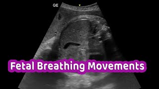 Fetal Breathing Movements [upl. by Percival]