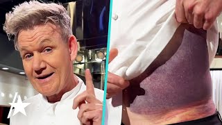 Gordon Ramsay Reveals MASSIVE Bruise After Bike Accident [upl. by Yoo]