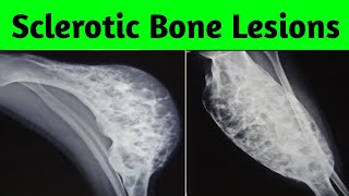 Multiple Sclerotic Bone Lesions Differential Diagnosis [upl. by Daus]