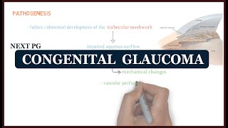 Congenital Glaucoma  ophthalmology  NEXT PG [upl. by Rausch]