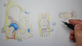 Hematogenous osteomyelitis in children [upl. by Cavuoto360]