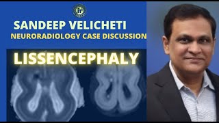 LISSENCEPHALY  SANDEEP VELICHETI  MRI BRAIN [upl. by Sell]