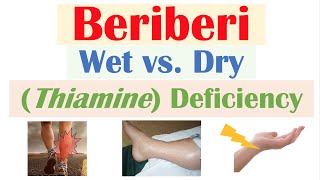 Beriberi Thiamine Deficiency Wet vs Dry Beriberi Pathophysiology Symptoms Diagnosis Treatment [upl. by Adel748]