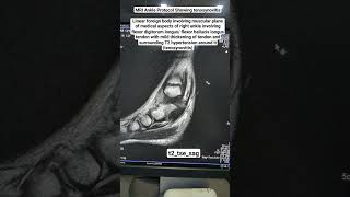 MRI Ankle Showing tenosynovitis in t2tsesag Sequence beginners [upl. by Adnaloy474]