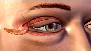 Cosmetic Eye and Eyelid Surgery  3D Medical Animation  ABP © [upl. by Huan]