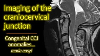 Imaging of Congenital Craniocervical Junction Anomalies [upl. by Sekofski646]