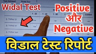 Widal Test Widal Test Positive Widal Test In Hindi Widal Test Report विडाल टेस्टWidaltestkaise [upl. by Sweet]