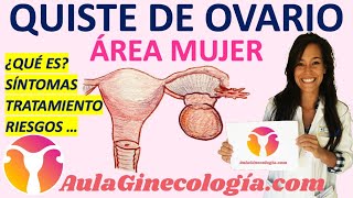 QUISTE DE OVARIO ¿QUÉ ES SÍNTOMAS TRATAMIENTO RIESGOS  Ginecología y Obstetricia [upl. by Liban]