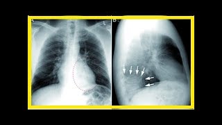 Behandlung von atypischer Pneumonie [upl. by Mallory]